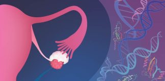 Early Detection of Ovarian Cancer May be Possible with Combination of Artificial Intelligence and Liquid Biopsies