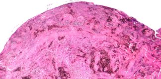 Pimicotinib Significantly Improves Outcomes for Patients with Tenosynovial Giant Cell Tumor