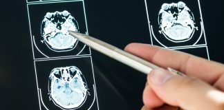 Investigational Drug May More than Double the Survival for Patients Diagnosed with Glioblastoma