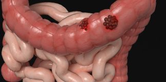 Results of the Breakwater Trial Shows Encorafenib to Improve Progression-Free Survival in Metastatic Colorectal Cancer