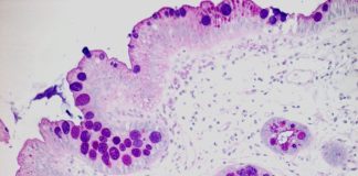 Organ Chip Platform Accurately and Actionably Predicts Therapy Response in Esophageal Adenocarcinoma
