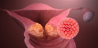 Study Shows Intranasal Vaccine Offers Promise as a Non-invasive Therapeutic Option for Treatment of Cervical Cancer