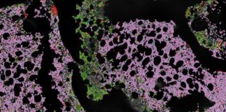 A New ‘Atlas’ of Inflammatory Immune Cells in Lays Foundation for More Reliable Prognosis