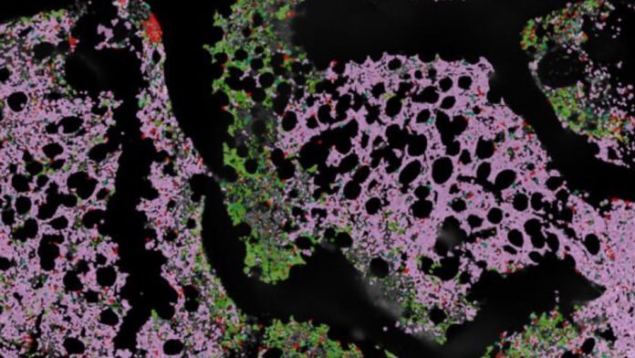 myeloma-ding-primary1