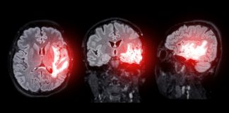 First Patient Enrolled in Oncopeptides’ Window-of-Opportunity Study Evaluating Peptide Drug Conjugate in Glioblastoma