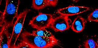 Study: Pro-inflammatory Macrophages Increase the Aggressiveness of Melanoma Cell Via Extracellular Vesicles