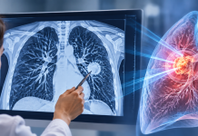 Precision Radiation Therapy in Inoperable Early-Stage Lung Cancer: What SWOG/NRG S1914 Tells Us
